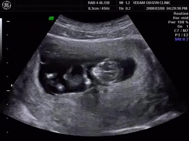 Wideo przedstawiające płód w 11 tygodniu ciąży