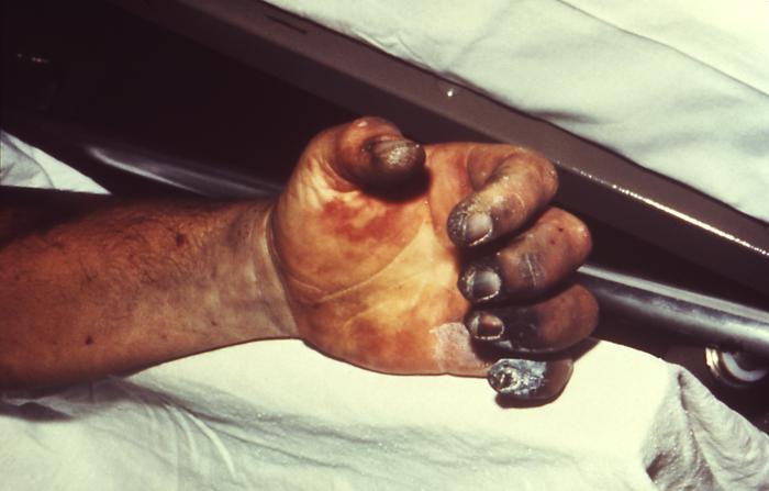 Palce pacjenta z rozpoznanądżumą septyczną ( fot. CDC/ Dr Jack Poland-Wikipedia)
