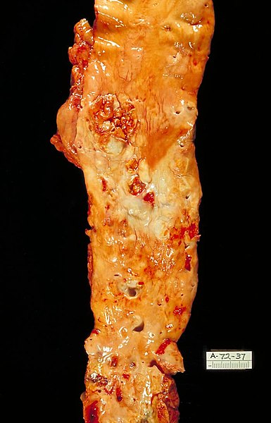 Preparat sekcyjny aorty z widocznymi rozległymi zmianami miażdżycowymi (fot.Wikipedia)