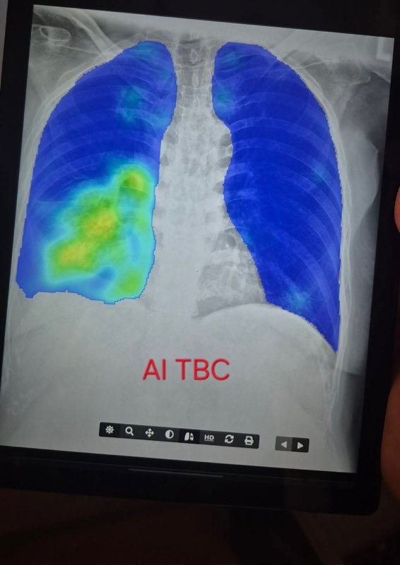 Zdjęcie wykonane przez mobilny aparat do diagnostyki gruźlicy o wadze trzech kilogramów, wykorzystywany m.in. w Ukrainie